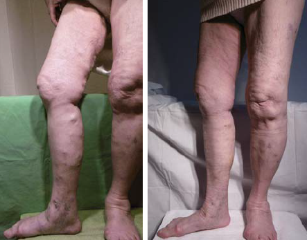 Idős nőbeteg panaszokat okozó varicositásának ragasztós műtét előtti és utáni képe