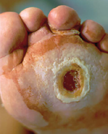 Cukorbeteg láb. A mély talpi sebet vaskos keratózis, callus veszi körül.
