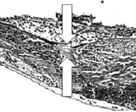 End-to-end lézeres microvascularis anastomosis szövettani képe