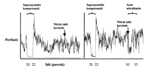Intermittáló transzdermális nitrátkezelés mellett alkalmazott szublingvális nitrát perifériás érhatásának monitorozása
