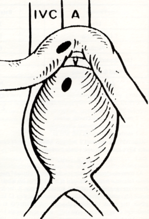 Az aorto-duodenalis fistulákról