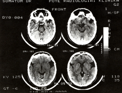 Az agyi aneurysmák CT-vizsgálatáról
