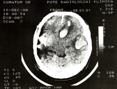 Az agyi aneurysmák CT-vizsgálatáról