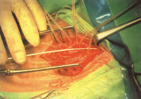 Intraoperatív carotis interna stent implantatio videoangioszkópiás kontroll mellett