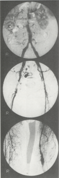 Acut alsó végtagi ischaemiát okozó poplitea aneurysmákról