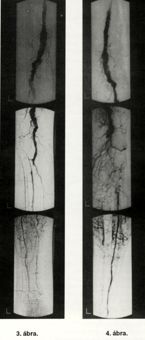 Acut alsó végtagi ischaemiát okozó poplitea aneurysmákról