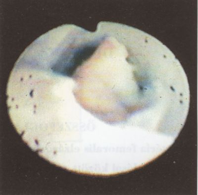 Femoro-poplitealis thrombendarteriectomiák videoangioscopos kontroll mellett