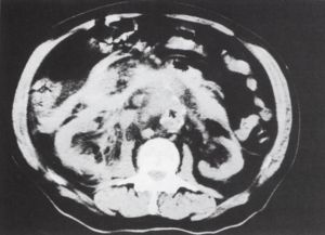 A spirál CT a sürgősségi vascu1aris radiológiában