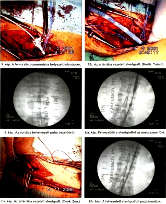 AAA új műtéti megoldása: stentgraft