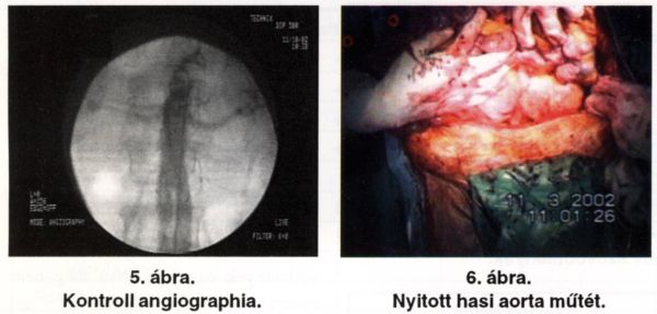 Infrarenalis hasi aorta aneurysma (AAA) stentgraft versus nyitott műtét