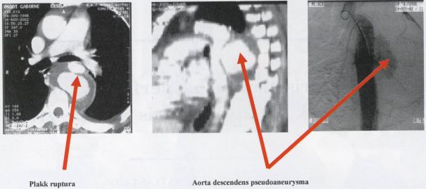 Alimentáris traktusba perforált aorta aneurysmák endovascularis kirekesztése