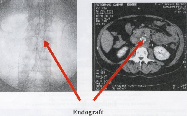 Alimentáris traktusba perforált aorta aneurysmák endovascularis kirekesztése