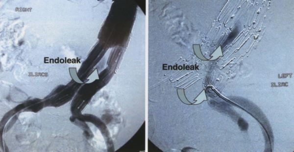 Endovascularis aorta műtéteink eredményei - computer tomográffal végzett 54 hónapos követés