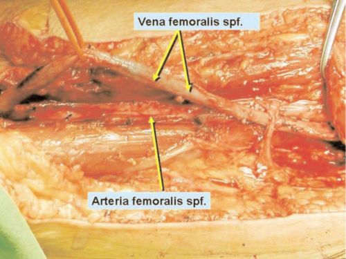 Aorto-bifemoralis graft készítése vena femoralis superficialisból