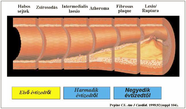 Perifériás artériás betegség (PAB) és a komplex kardiovaszkuláris prevenció