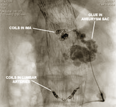Többszörös endoleak, aorta aneurysma endoprotézis-műtét után.