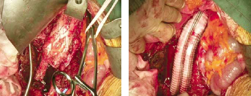 Többszörös endoleak, aorta aneurysma endoprotézis-műtét után.