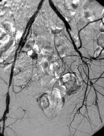 Kétoldali carotis interna szignifikáns szűkületének együléses neurointervenciós kezelése