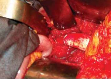 Közép-aorta szindroma kezelése aorto-aorticus bypass műtéttel