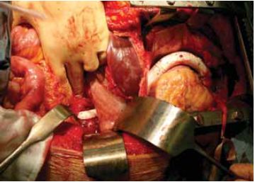 Közép-aorta szindroma kezelése aorto-aorticus bypass műtéttel