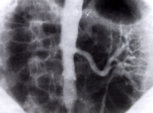 Az aorta dissectio mai kezelési lehetőségeiről - A-típusú acut dissectio sikerrel operált esete