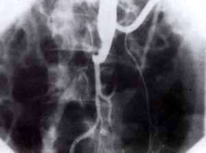 Az aorta dissectio mai kezelési lehetőségeiről - A-típusú acut dissectio sikerrel operált esete
