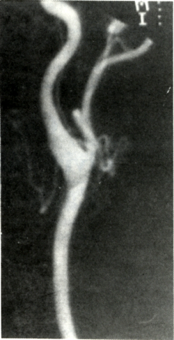 Carotis keringési zavar kivizsgálása során diagnosztizált Eagle (stylohyoid) szindróma