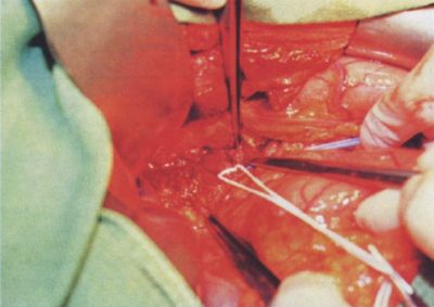 Leriche syndroma és zsigeri artériás kompresszió együttes kezelési stratégiája