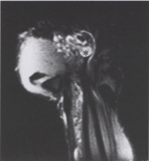 A tenyér artériás árkádjának ritka benignus daganata