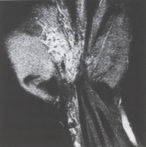 A tenyér artériás árkádjának ritka benignus daganata