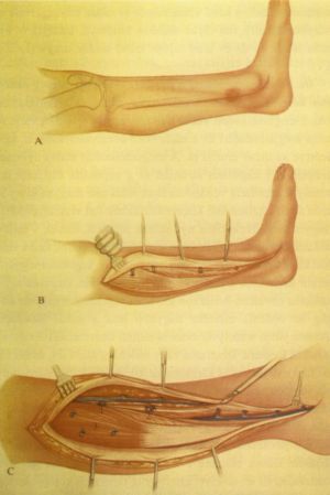 A lábszárfekély műtéti kezelésének története - 100 éve született Robert R. Linton