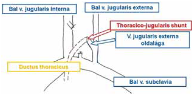 A thoracico-jugularis shunt vázlata