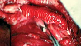 Nyílt TEA és DeBakey graftból
kivágott folt az arteria iliaca communison