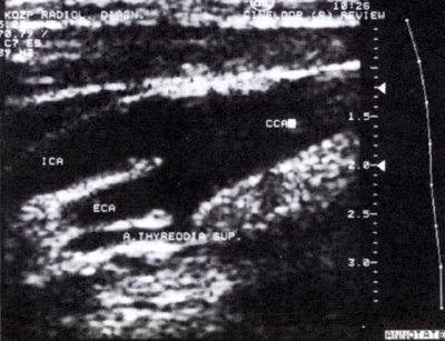 A carotis rendszer duplex ultrahang vizsgálata