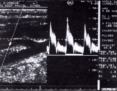 A carotis rendszer duplex ultrahang vizsgálata