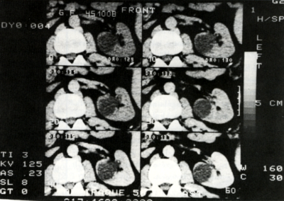 A vesetumorok vaseularisatiójának és vénás terjedésének komputer tomográfiás vizsgálata