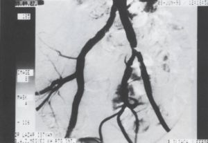 Primer vascularis stentbeültetések: 21 beteggel szerzett tapasztalataink