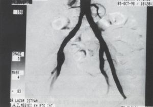 Primer vascularis stentbeültetések: 21 beteggel szerzett tapasztalataink