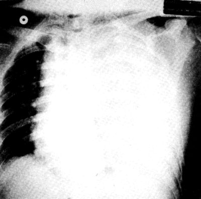 Traumás thoracalis aorta ruptura műtéti ellátása
