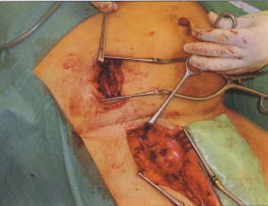 Sapheno-peritonealis shunt új műtéti technika a refracter ascites kezelésében