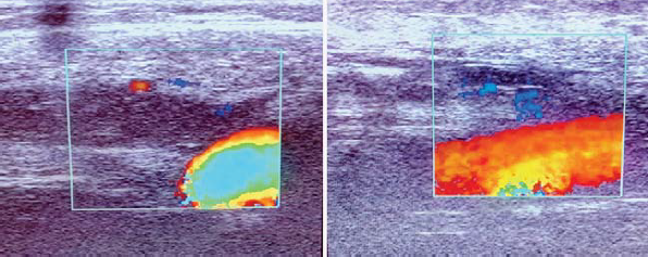 Ultrahang képek a sapheno-femoralis junkcióról