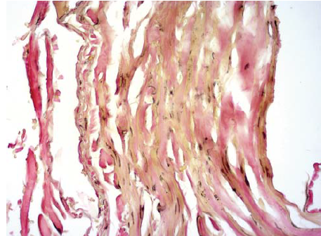 A v. saphena magna részlete az endovénás hegesztés után
