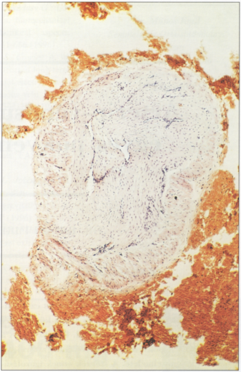 Arterio-venosus mikroshuntök egyes pókvénák hátterében