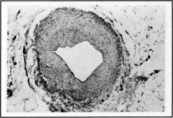 Arterio-venosus mikroshuntök egyes pókvénák hátterében