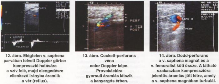 A visszerek duplex ultrahang vizsgálata