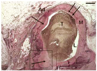 A v. saphena magna vasa vasorumainak anatómiája normális és patológiás körülmények között