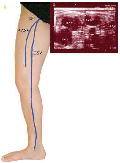 Az alsó végtag krónikus véna betegségeinek ultrahang vizsgálata - UIP konszenzus dokumentum. II. rész. Anatómia.