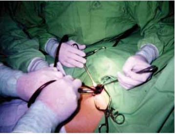 Az ascendáló varicophlebitis hagyományos műtéti kezelése