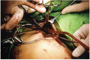 Az ascendáló varicophlebitis hagyományos műtéti kezelése
