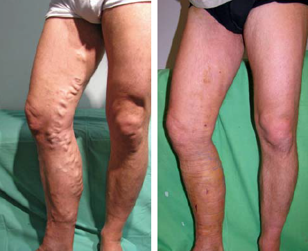 Vena saphena magna törzs-varicositas lézer-műtét előtt és után.